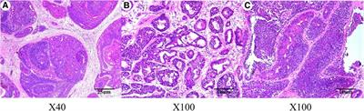 Case report and literature review: Malignant adenomyoepithelioma after breast augmentation